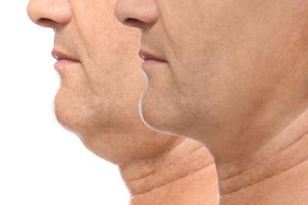 HIFU - Breakthrough in Anti - ageing 2 hifu results Northwood