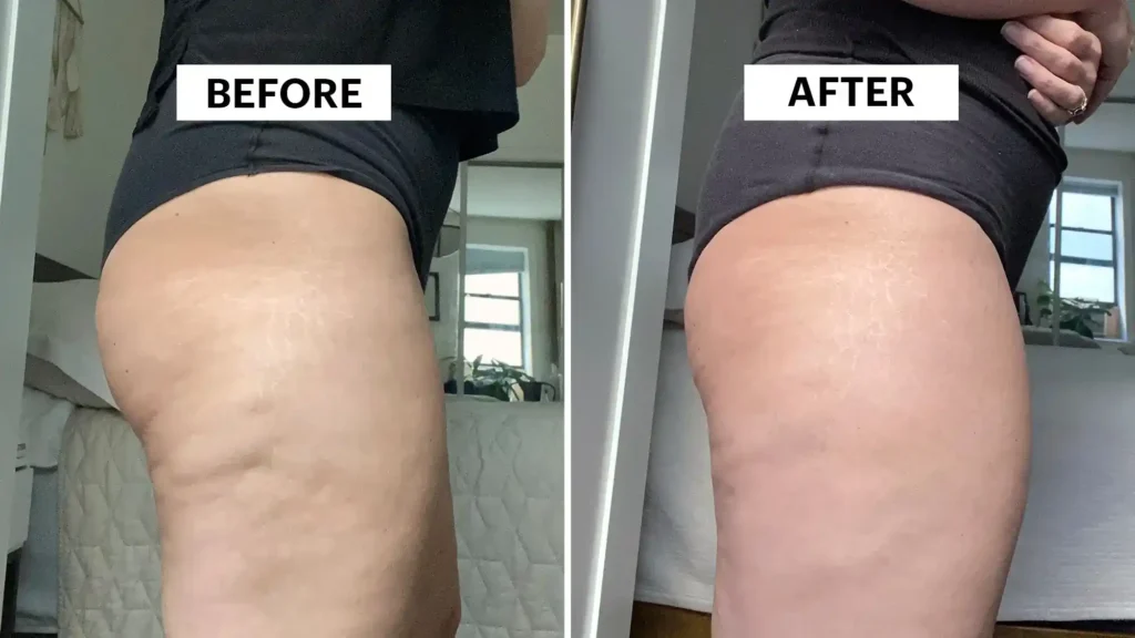 Sculpting Your Bum: Can Toning Exercises Really Reduce Cellulite? 1 Do Toning Exercise Northwood Really Tackle Cellulite?