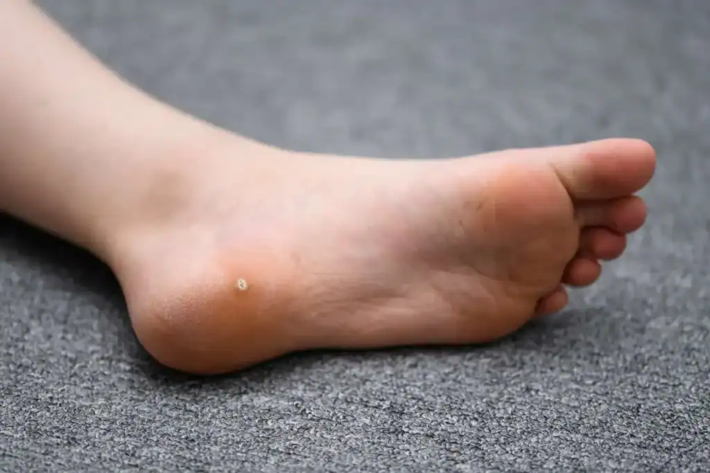Cryotherapy For Warts And Also Verrucas 2 Image of verruca on the bottom of the foot that able to be treated with Cryotherapy Northwood