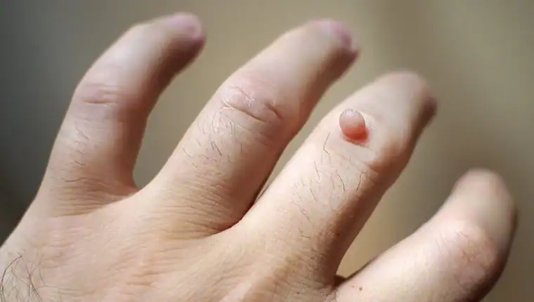 Cryotherapy For Warts And Also Verrucas 1 Image of blemish that Cryotherapy Northwood can remove with Lipo 360.