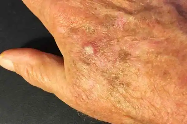 Cryopen For Actinic Keratoses 1 Image of Actinic keratoses Northwood on a person hand