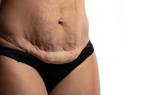 The Science of Skin Tightening 1 The science behind skin tightening Northwood picture of a woman's sagging skin on the stomach
